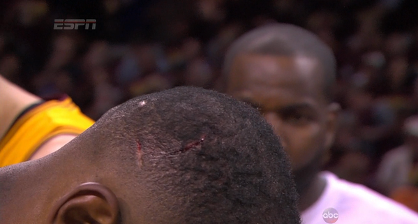 LeBron James Collides With NBA Photographers, Gashes His Head Open