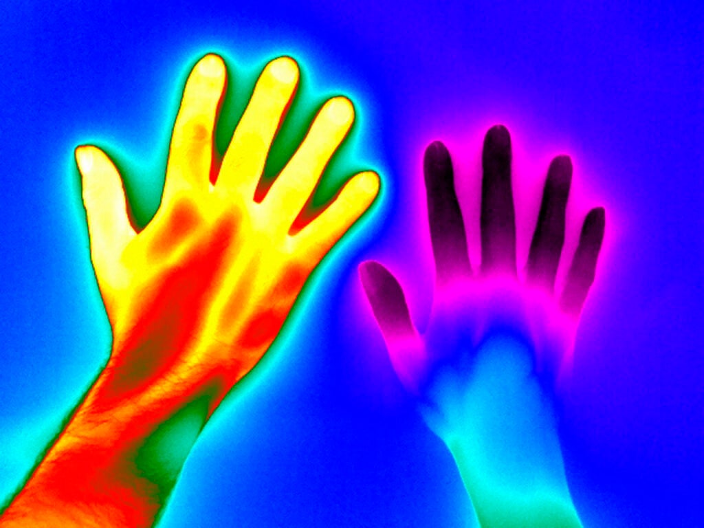 Raynaud's Disease